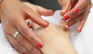 Person receiving dry needling on the arm